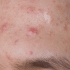 Photo of acne on forehead